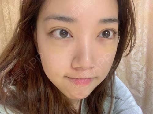 激光去眼袋视频全过程,术前术后护理与效果展示